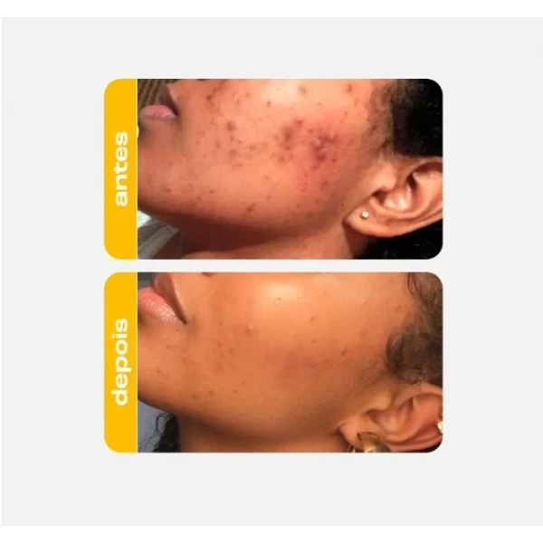 CREAMY - ÁCIDO LÁTICO + NIACINAMIDA ANTIACNE 30g